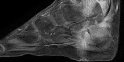 Випадок фаготерапії кістково-суглобової інфекції у дитини