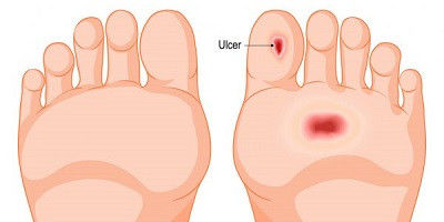 Бактеріофаги в лікуванні інфікованої діабетичної стопи: стан справ