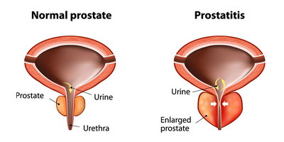 Фаготерапія бактеріального простатиту