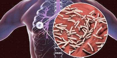 Мікобактеріофаги: коктейль проти туберкульозу